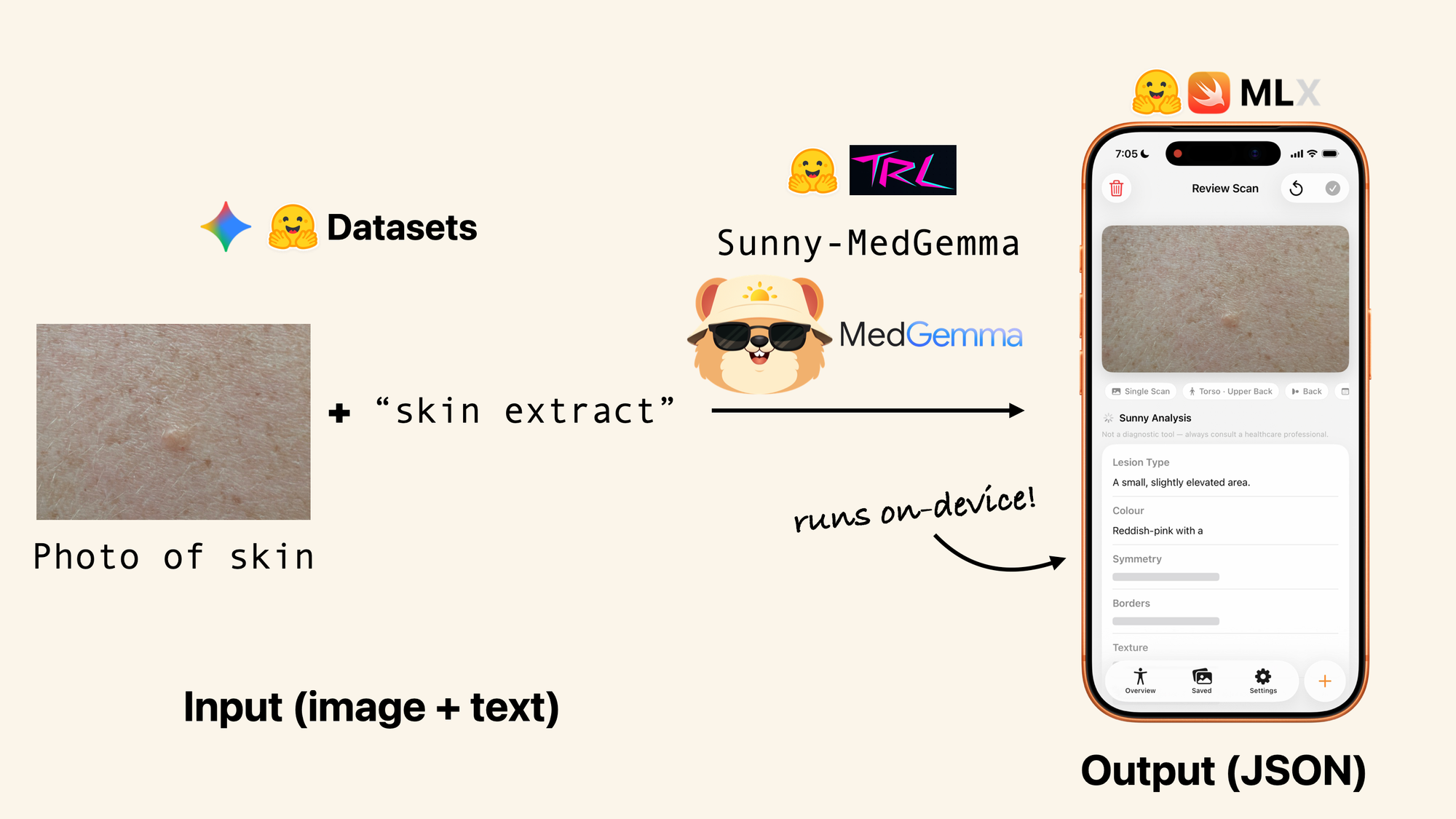 Gemini said This diagram illustrates a workflow where a 'Photo of skin' and 'skin extract' text are processed by the 'Sunny-MedGemma' model to generate a structured 'Output (JSON)'. The process features logos for Hugging Face, TRL, and MLX, highlighting that the final analysis 'runs on-device!' within a mobile application interface.